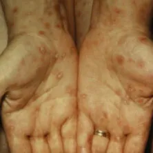 Syphilis symptoms on a person's hands