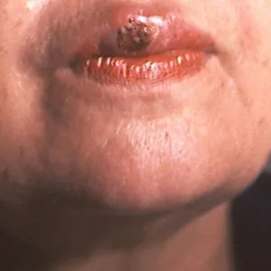 Syphilis symptoms on a person's mouth