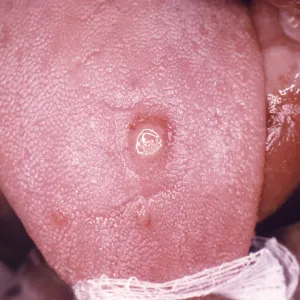 Syphilis symptoms on a person's tongue