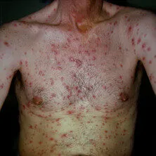 Syphilis symptoms on a person's torso